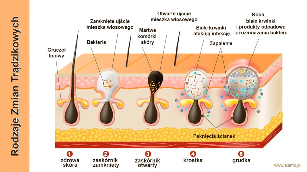 rodzaje trądziku pospolitego (acne vulgaris)