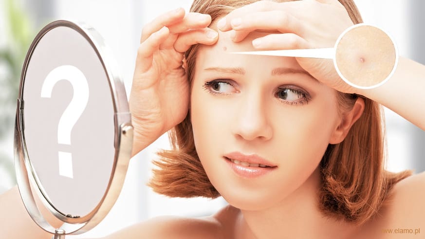 jak zwalczyć trądzik - młoda kobieta przegląda w lustrze objawy trądziku